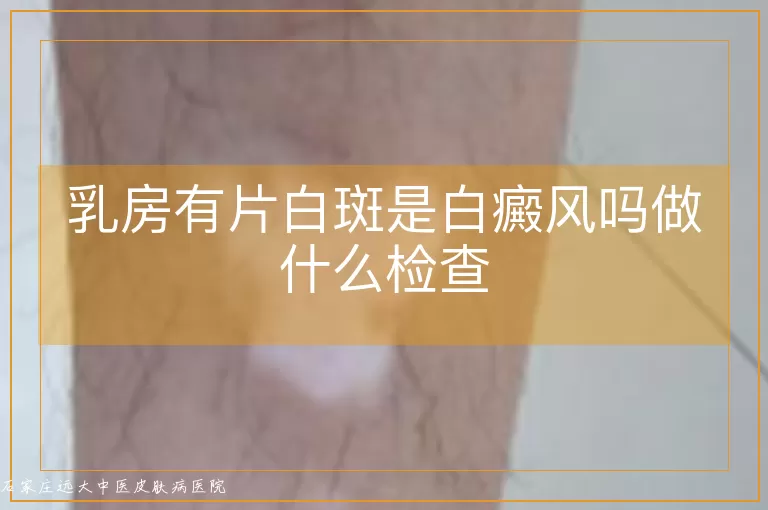 乳房有片白斑是白癜风吗做什么检查