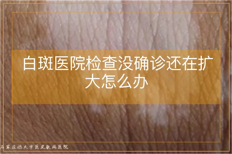 白斑医院检查没确诊还在扩大怎么办