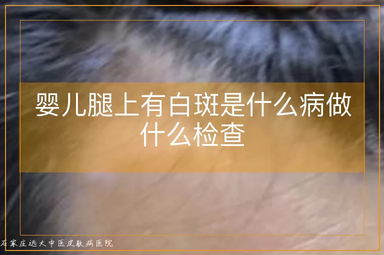 婴儿腿上有白斑是什么病做什么检查