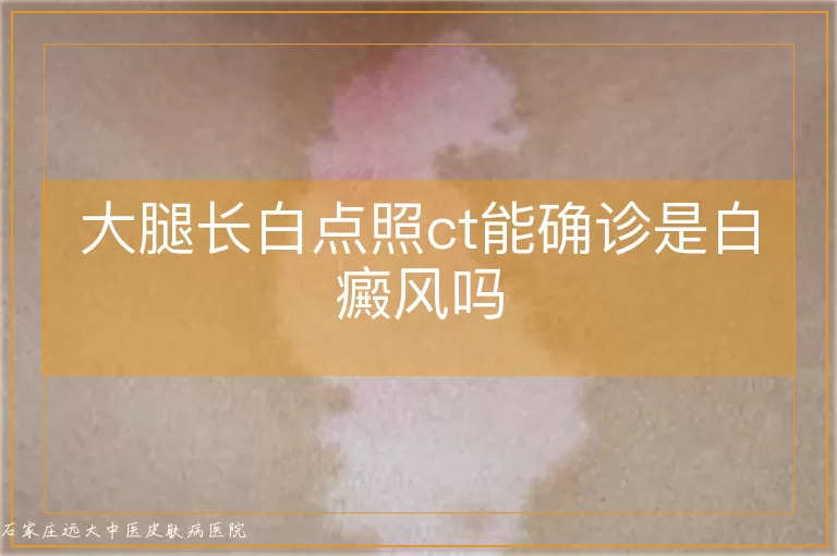 大腿长白点照ct能确诊是白癜风吗