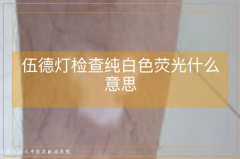 伍德灯检查纯白色荧光什么意思