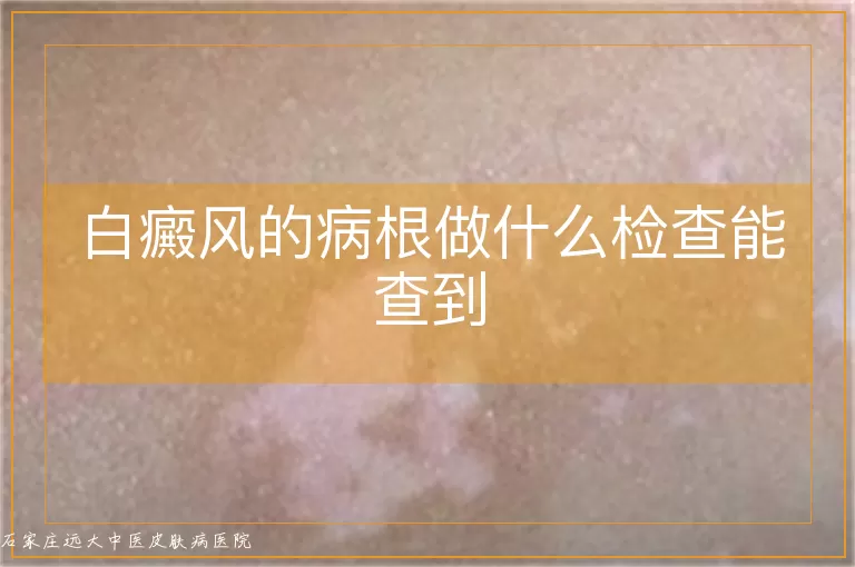 白癜风的病根做什么检查能查到