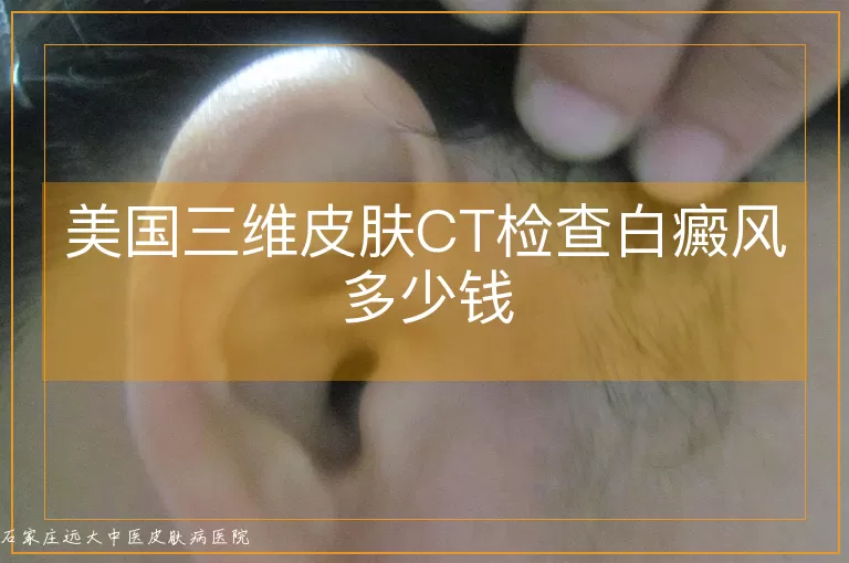 美国三维皮肤CT检查白癜风多少钱