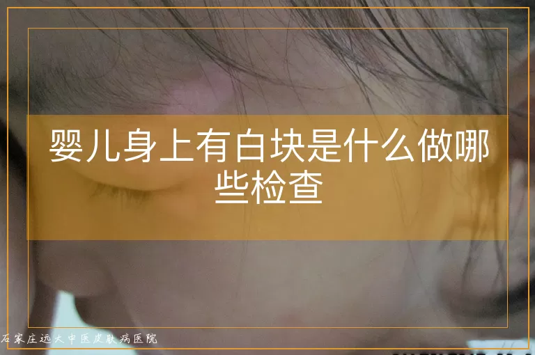 婴儿身上有白块是什么做哪些检查