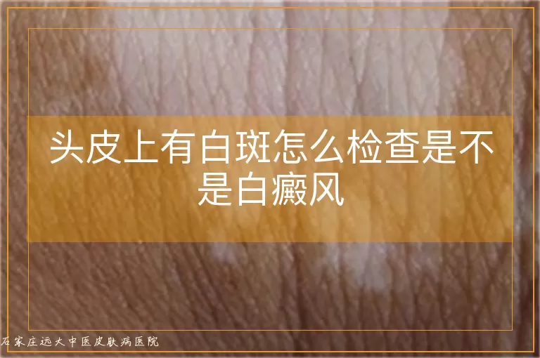 头皮上有白斑怎么检查是不是白癜风