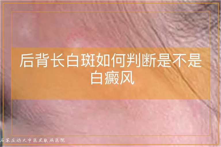 后背长白斑如何判断是不是白癜风