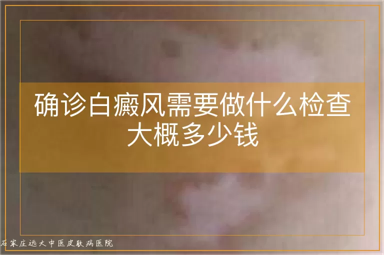 确诊白癜风需要做什么检查大概多少钱