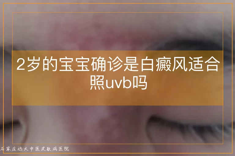 2岁的宝宝确诊是白癜风适合照uvb吗