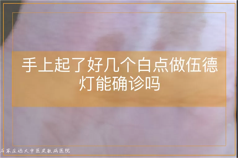 手上起了好几个白点做伍德灯能确诊吗