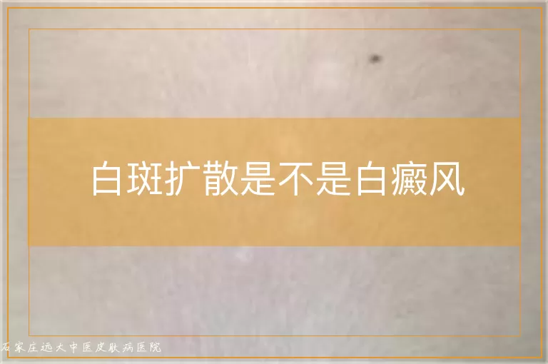 白斑扩散是不是白癜风