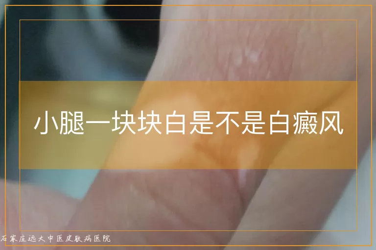 小腿一块块白是不是白癜风