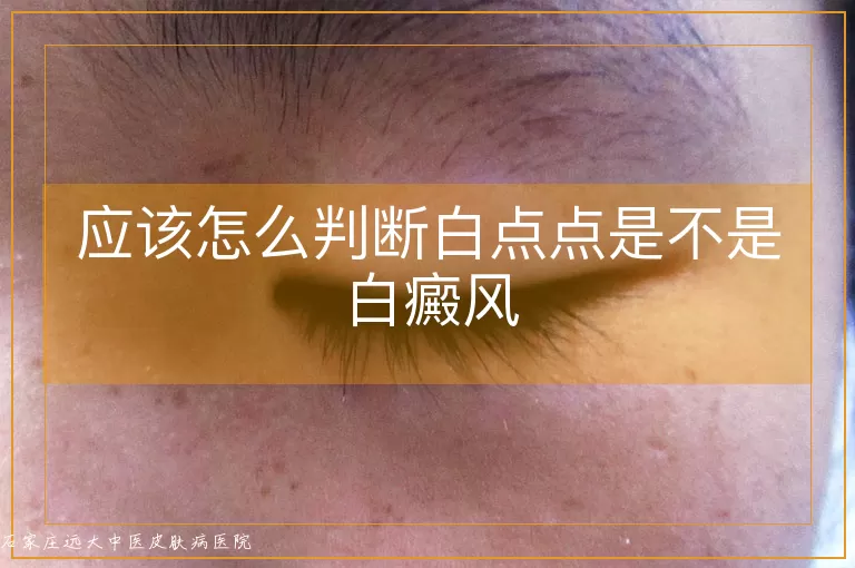 应该怎么判断白点点是不是白癜风