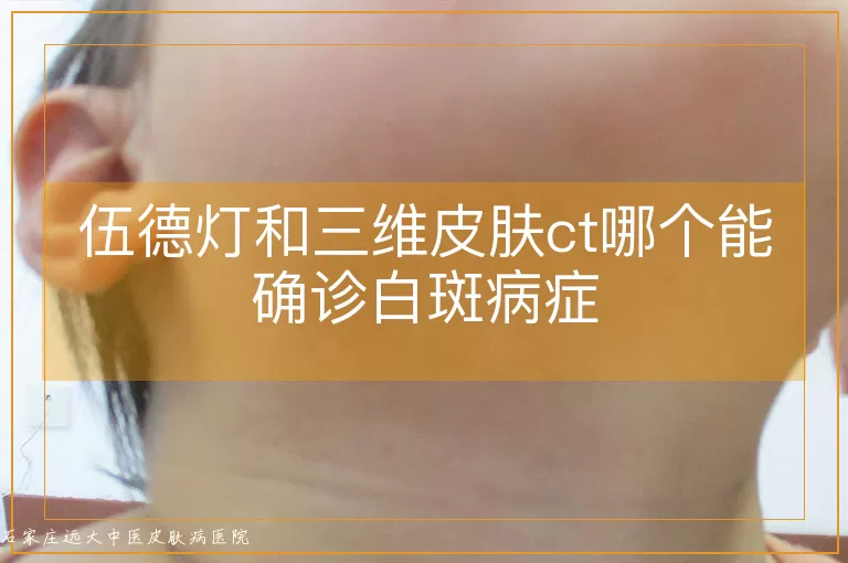伍德灯和三维皮肤ct哪个能确诊白斑病症
