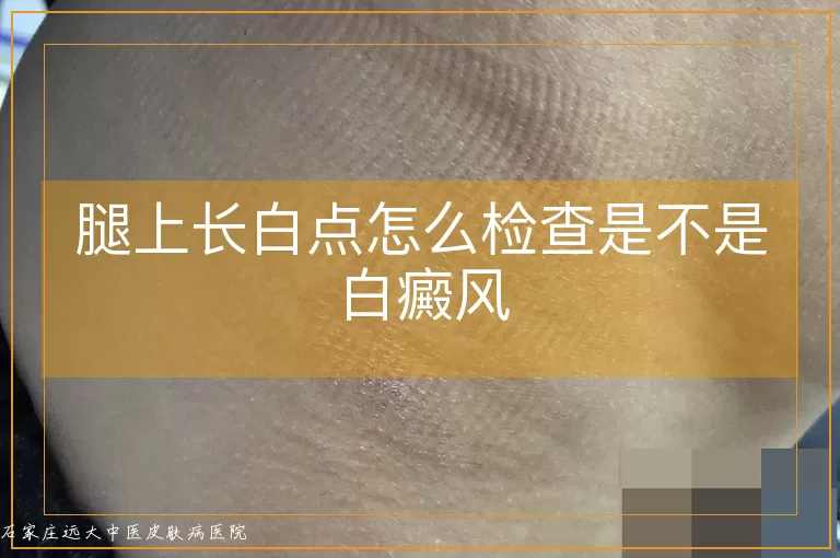 腿上长白点怎么检查是不是白癜风