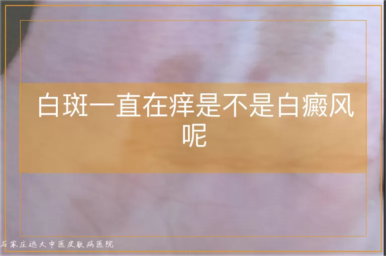 白斑一直在痒是不是白癜风呢