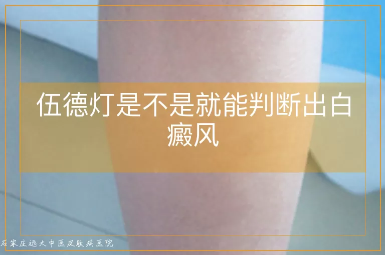 伍德灯是不是就能判断出白癜风