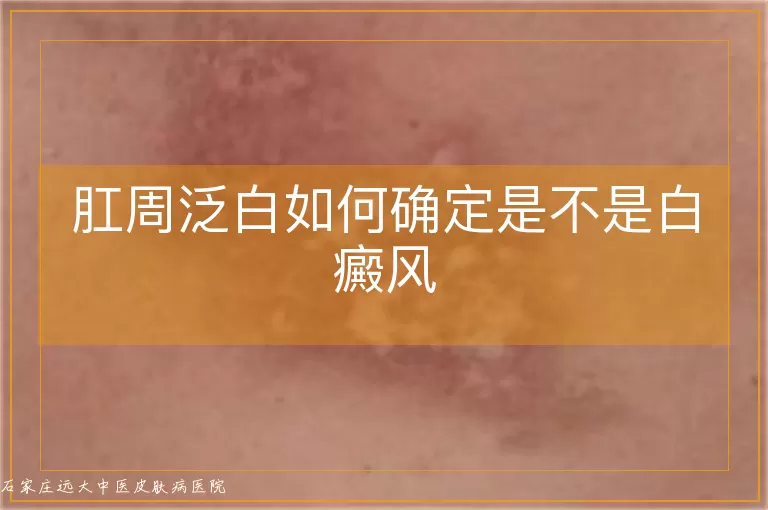 肛周泛白如何确定是不是白癜风