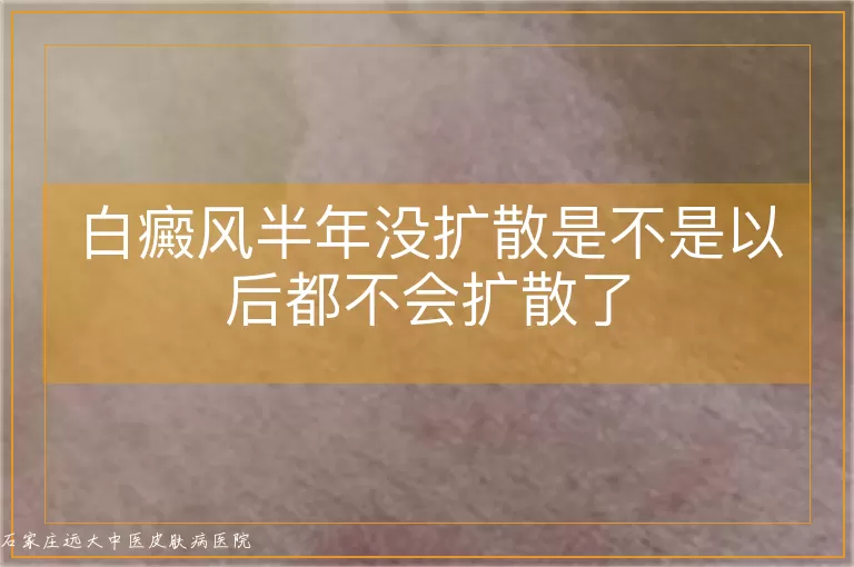 白癜风半年没扩散是不是以后都不会扩散了