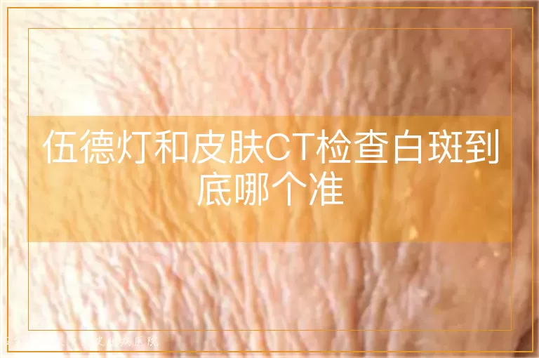 伍德灯和皮肤CT检查白斑到底哪个准