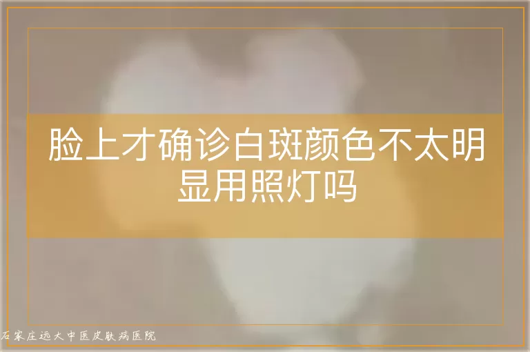 脸上才确诊白斑颜色不太明显用照灯吗