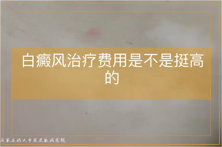 白癜风治疗费用是不是挺高的