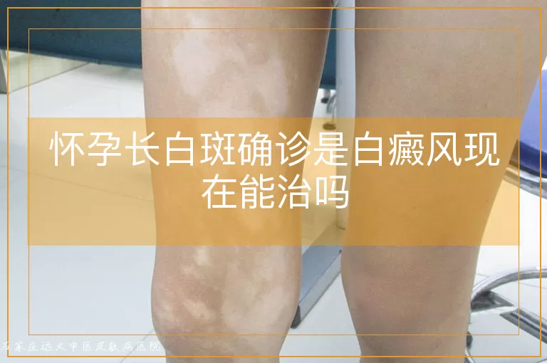 怀孕长白斑确诊是白癜风现在能治吗