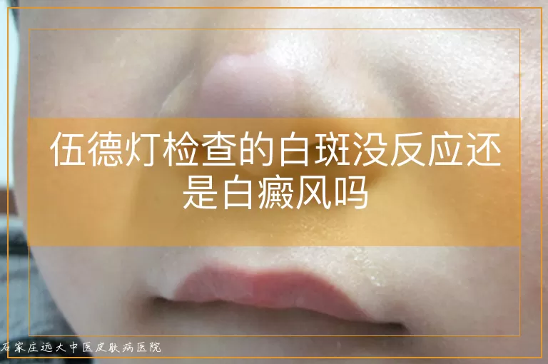 伍德灯检查的白斑没反应还是白癜风吗