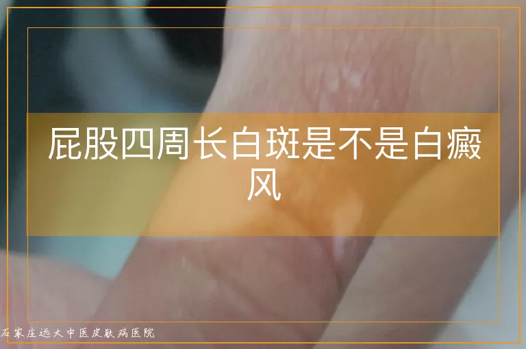 屁股四周长白斑是不是白癜风