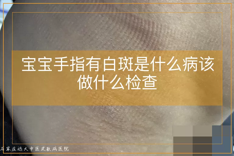 宝宝手指有白斑是什么病该做什么检查