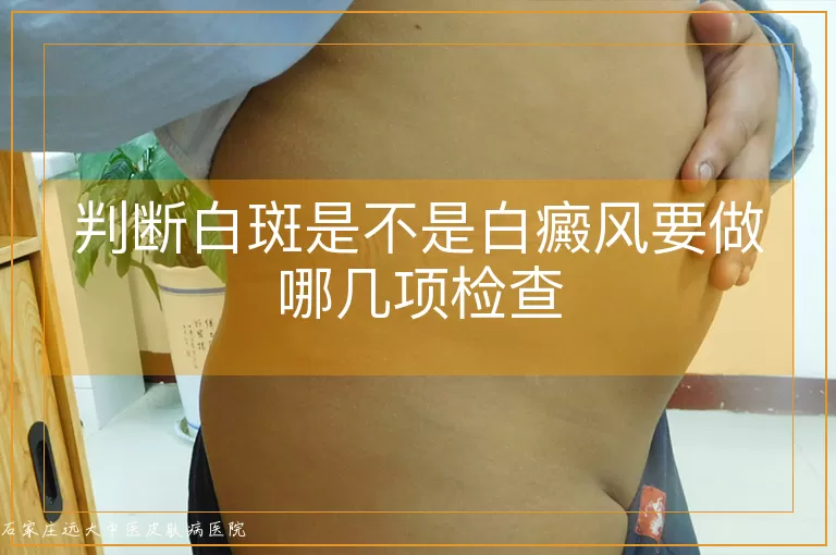 判断白斑是不是白癜风要做哪几项检查