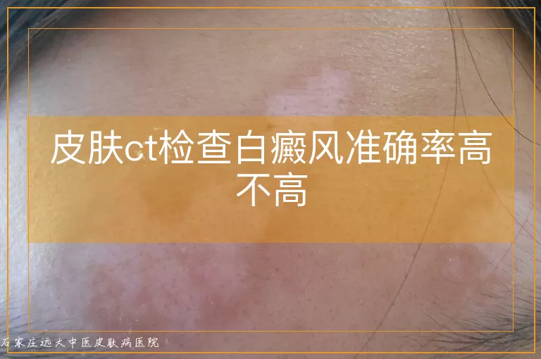 皮肤ct检查白癜风准确率高不高