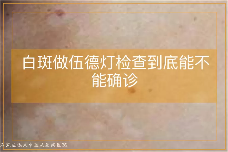 白斑做伍德灯检查到底能不能确诊