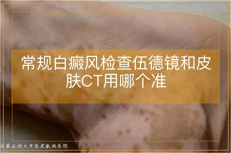常规白癜风检查伍德镜和皮肤CT用哪个准