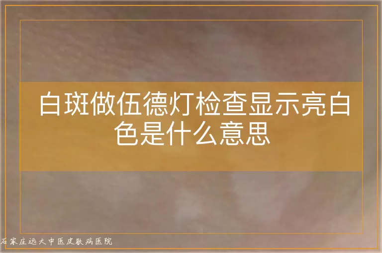 白斑做伍德灯检查显示亮白色是什么意思