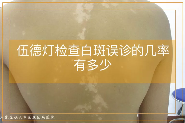 伍德灯检查白斑误诊的几率有多少