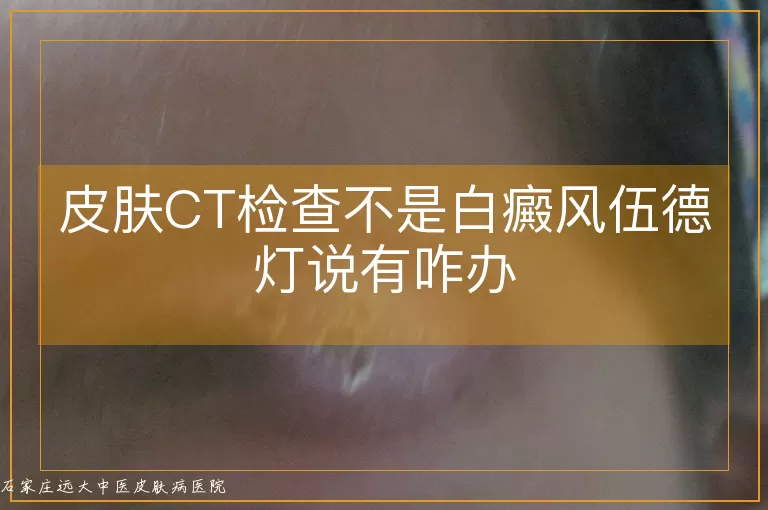 皮肤CT检查不是白癜风伍德灯说有咋办