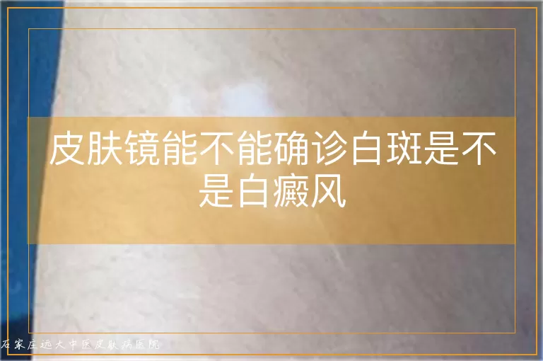 皮肤镜能不能确诊白斑是不是白癜风