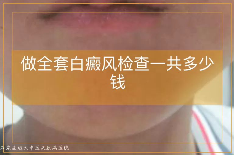 做全套白癜风检查一共多少钱