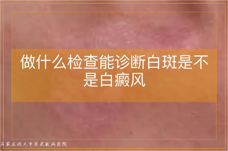 做什么检查能诊断白斑是不是白癜风