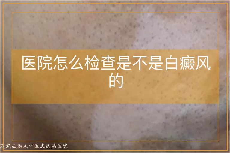 医院怎么检查是不是白癜风的