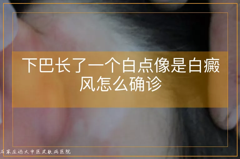下巴长了一个白点像是白癜风怎么确诊