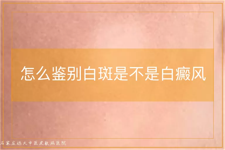 怎么鉴别白斑是不是白癜风