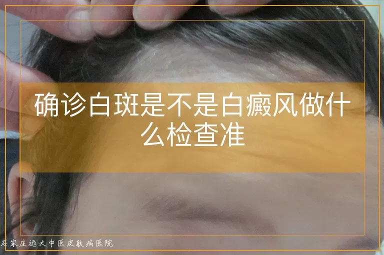 确诊白斑是不是白癜风做什么检查准