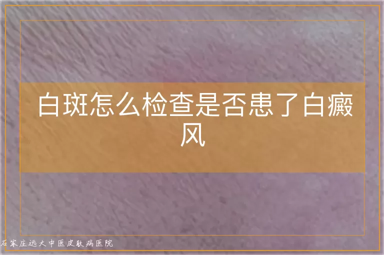 白斑怎么检查是否患了白癜风