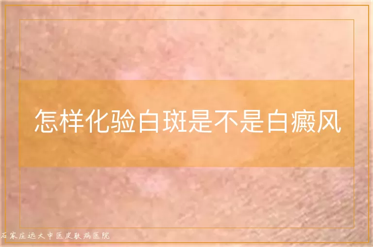 怎样化验白斑是不是白癜风