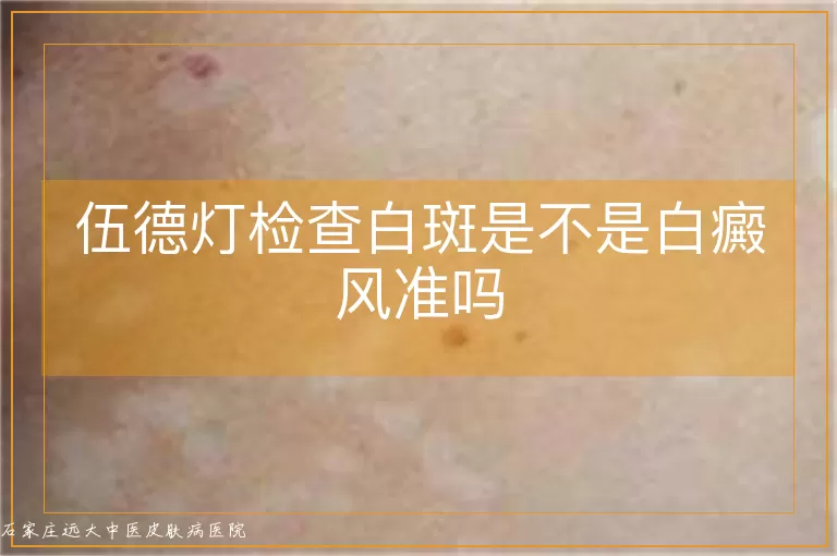 伍德灯检查白斑是不是白癜风准吗