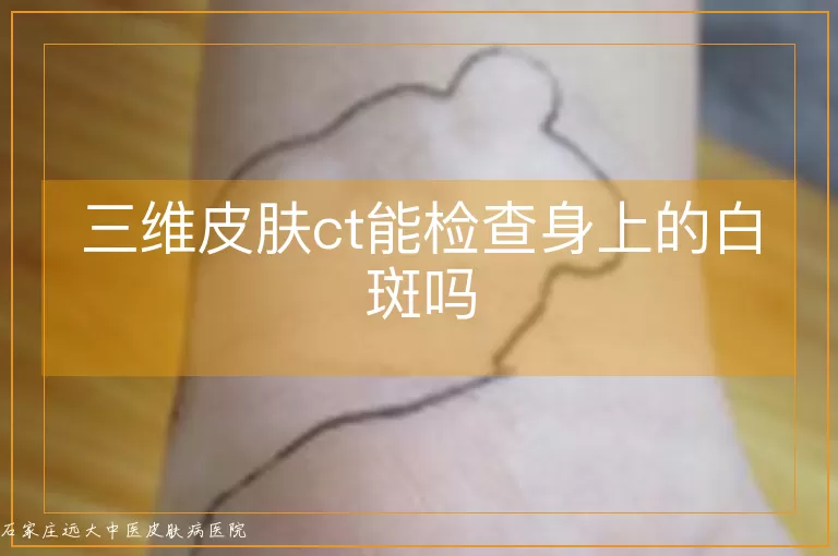 三维皮肤ct能检查身上的白斑吗