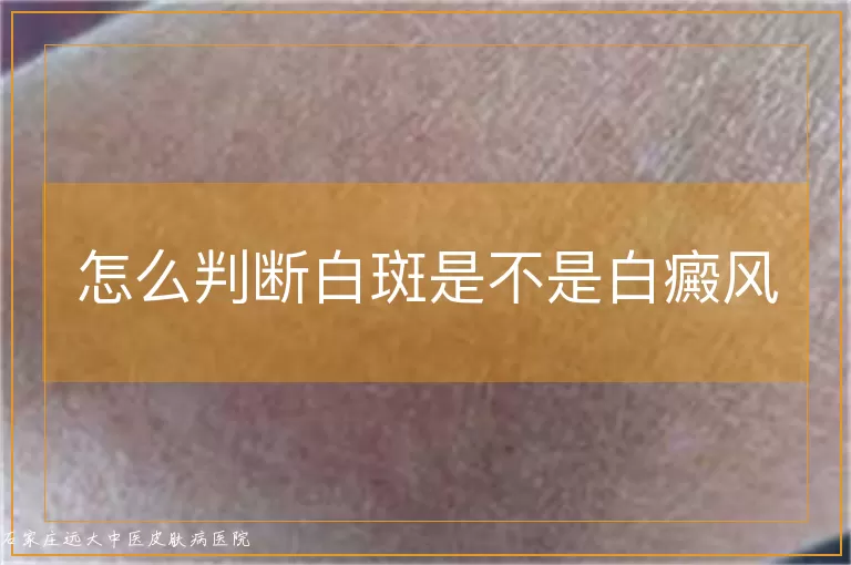 怎么判断白斑是不是白癜风