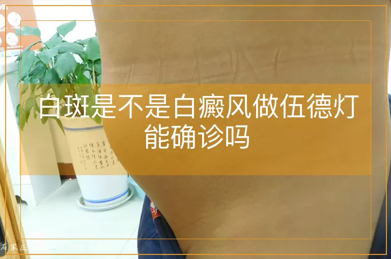 白斑是不是白癜风做伍德灯能确诊吗