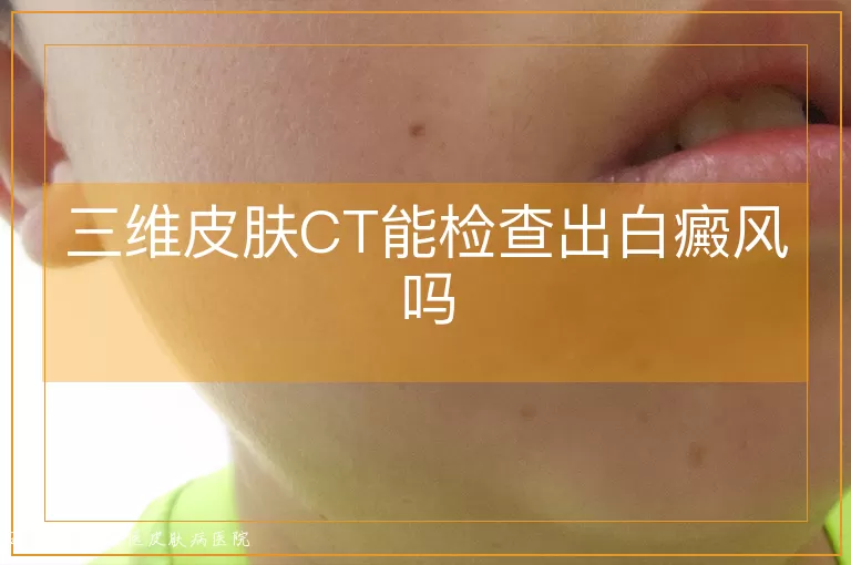 三维皮肤CT能检查出白癜风吗